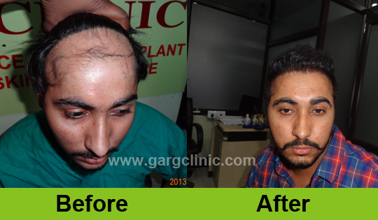 Garg Hair Transplant Clinic