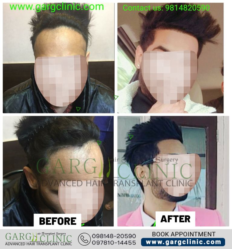Garg Hair Transplant Clinic