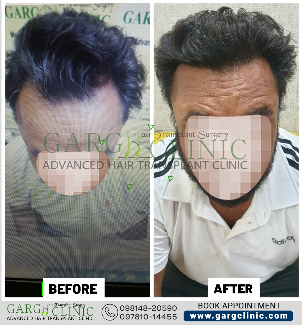 Garg Hair Transplant Clinic