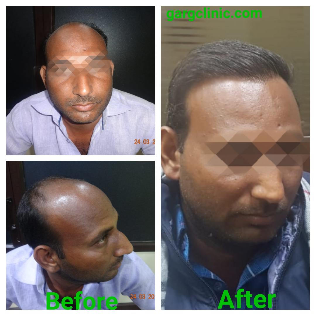 Garg Hair Transplant Clinic