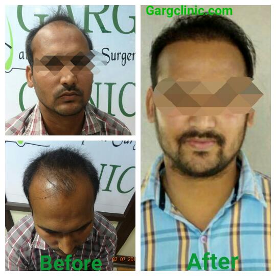 Garg Hair Transplant Clinic