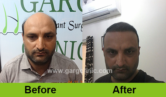 Garg Hair Transplant Clinic