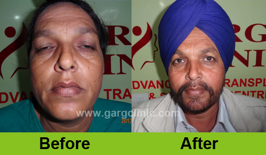Garg Hair Transplant Clinic