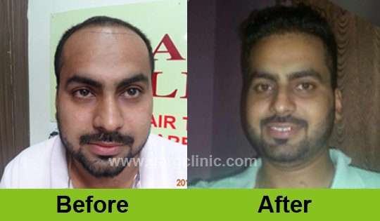Garg Hair Transplant Clinic