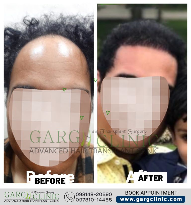 Garg Hair Transplant Clinic