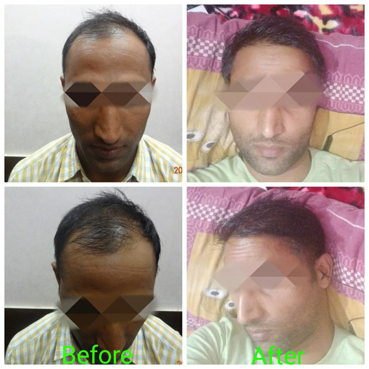 Garg Hair Transplant Clinic