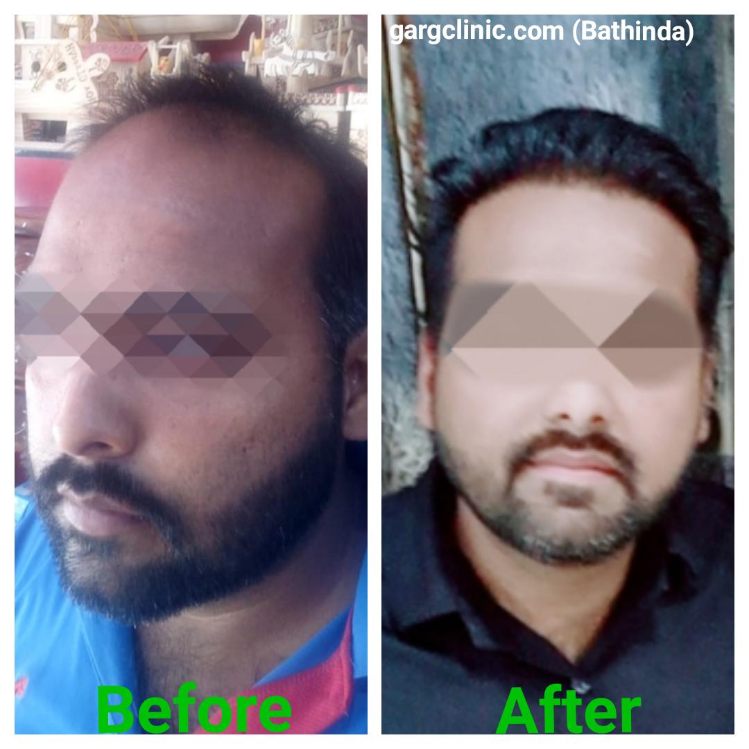 Garg Hair Transplant Clinic