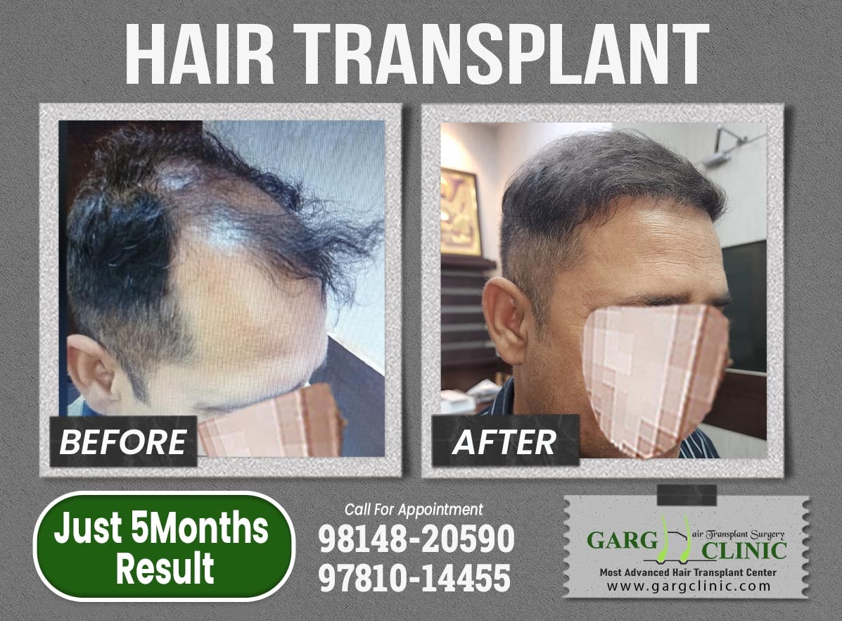 Garg Hair Transplant Clinic