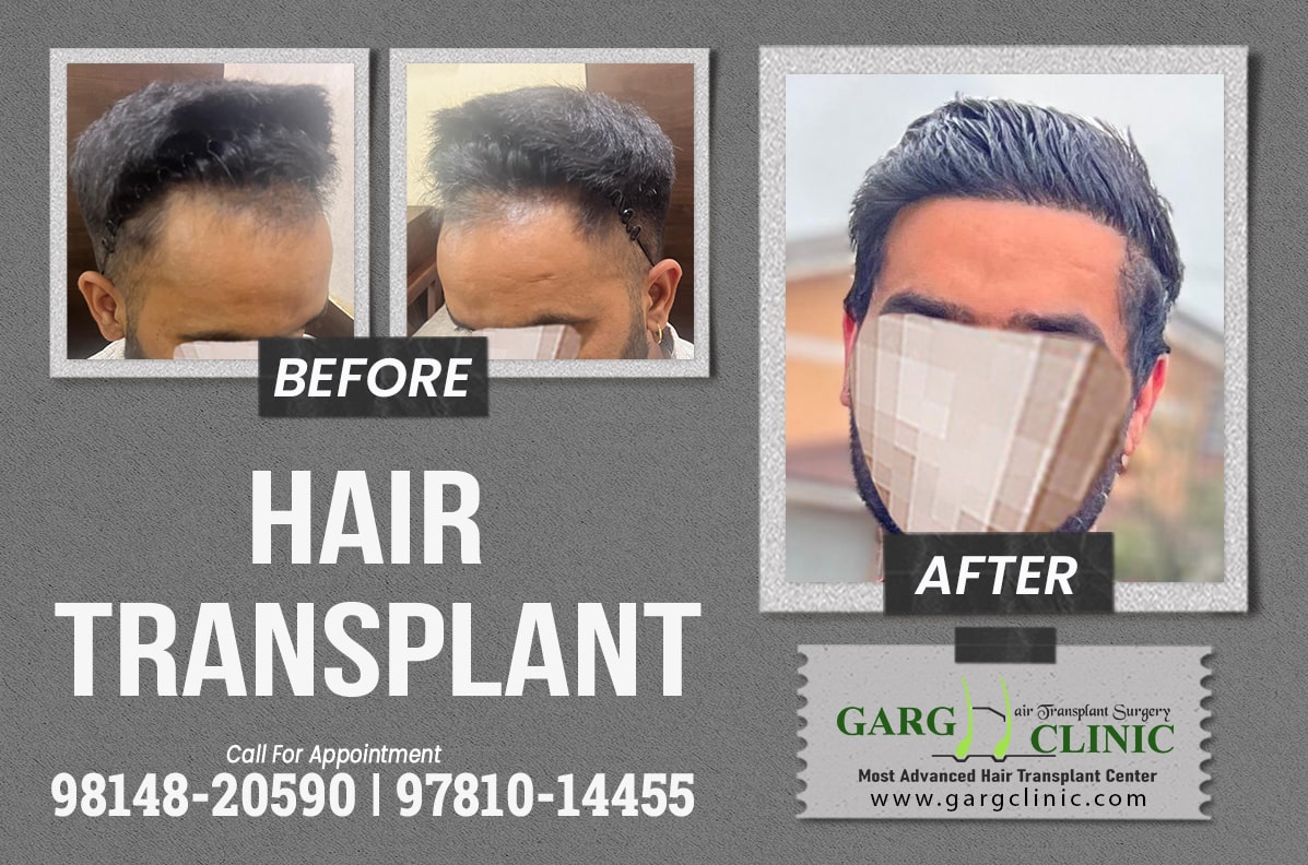 Garg Hair Transplant Clinic