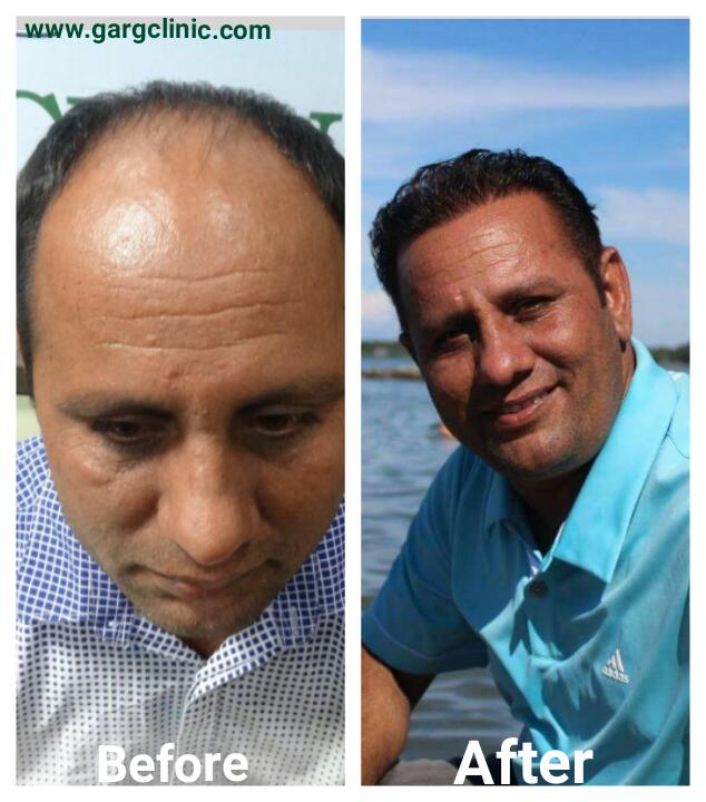 Garg Hair Transplant Clinic
