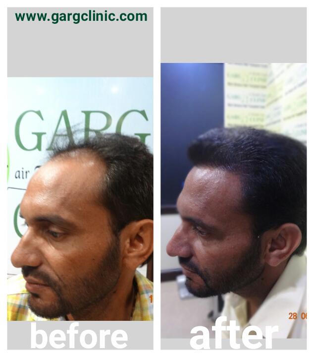 Garg Hair Transplant Clinic