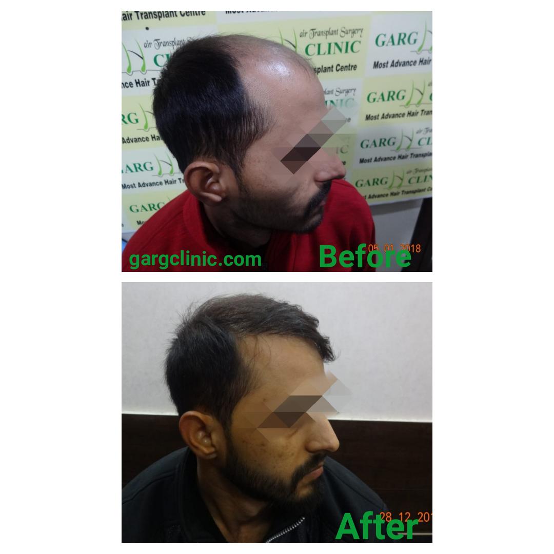 Garg Hair Transplant Clinic