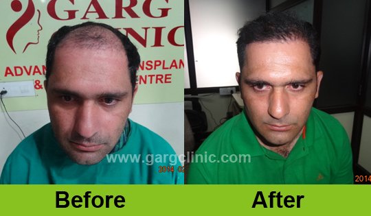 Garg Hair Transplant Clinic