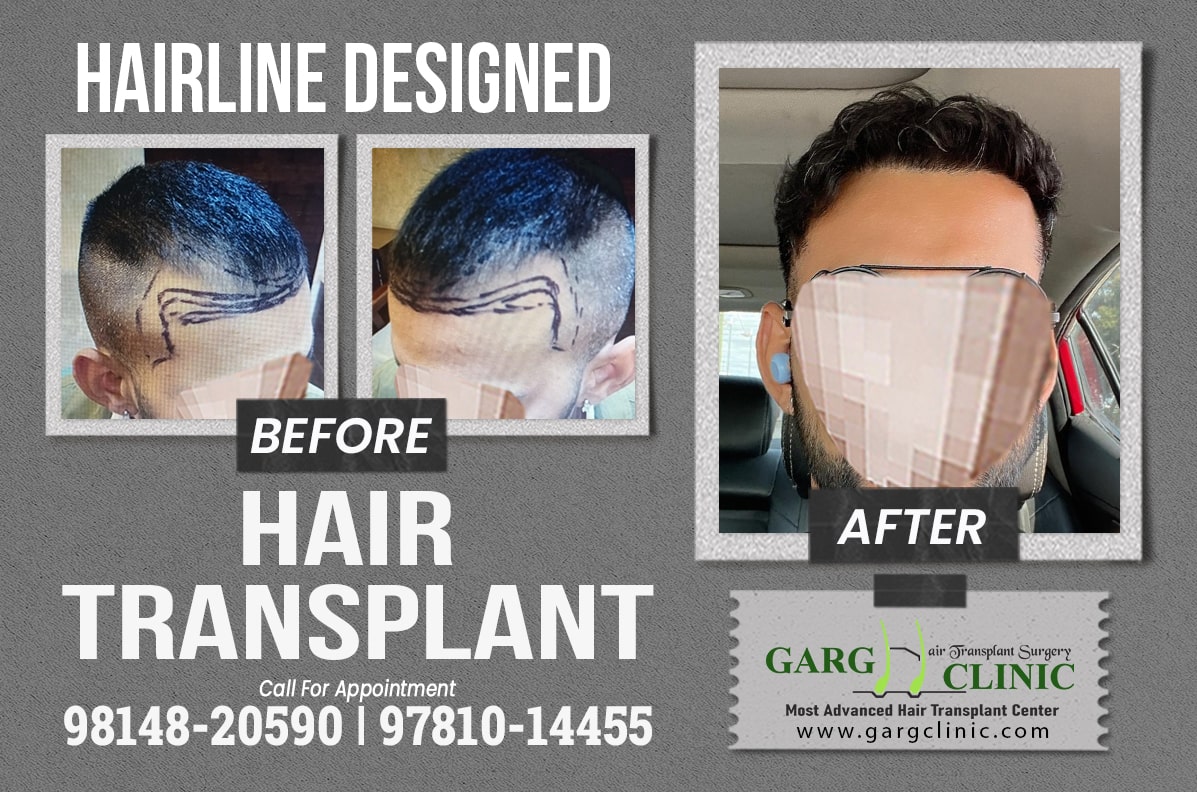 Garg Hair Transplant Clinic