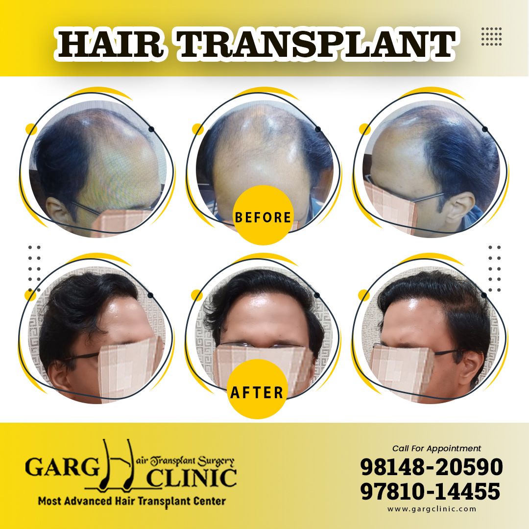 Garg Hair Transplant Clinic