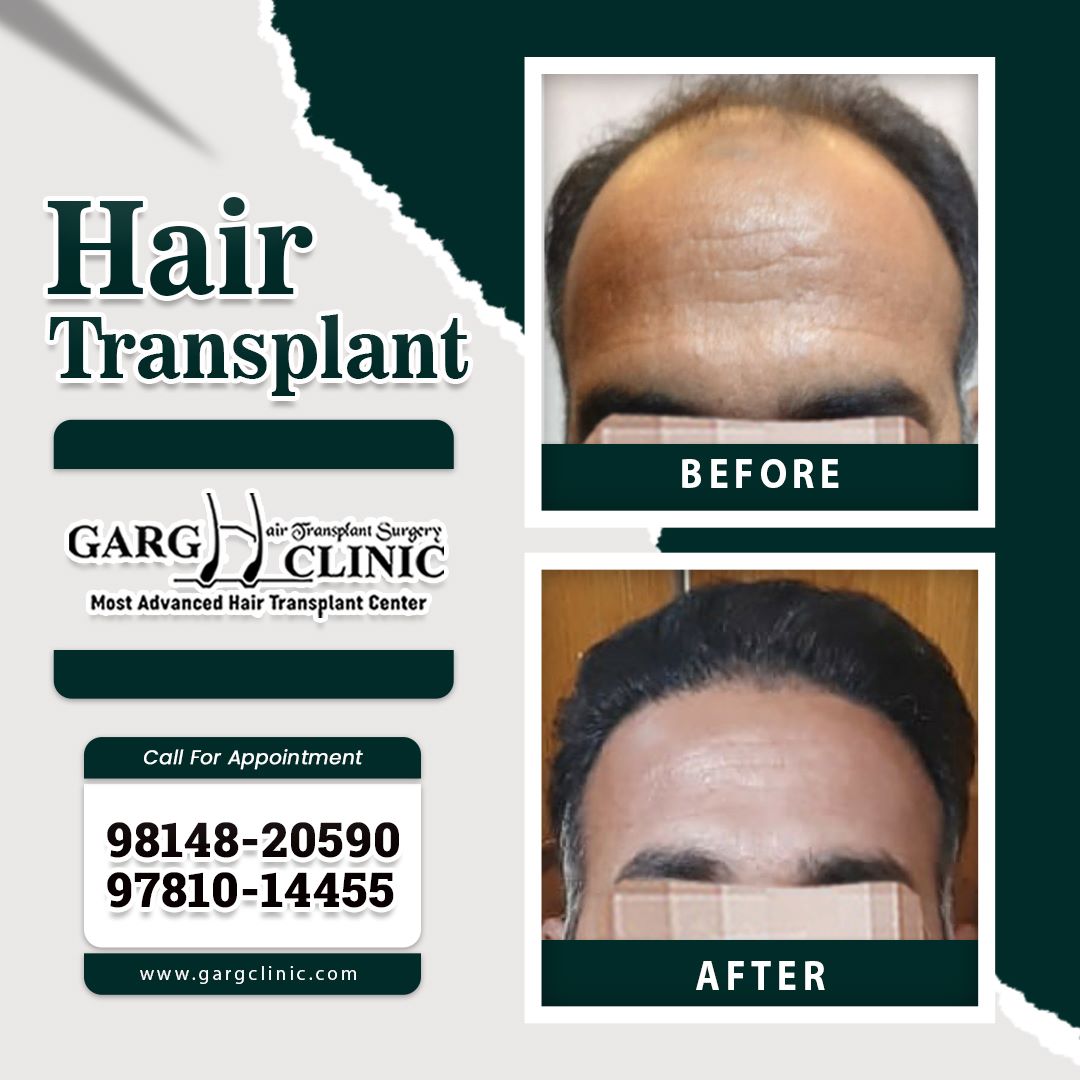 Garg Hair Transplant Clinic