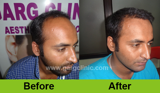 Garg Hair Transplant Clinic