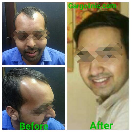 Garg Hair Transplant Clinic
