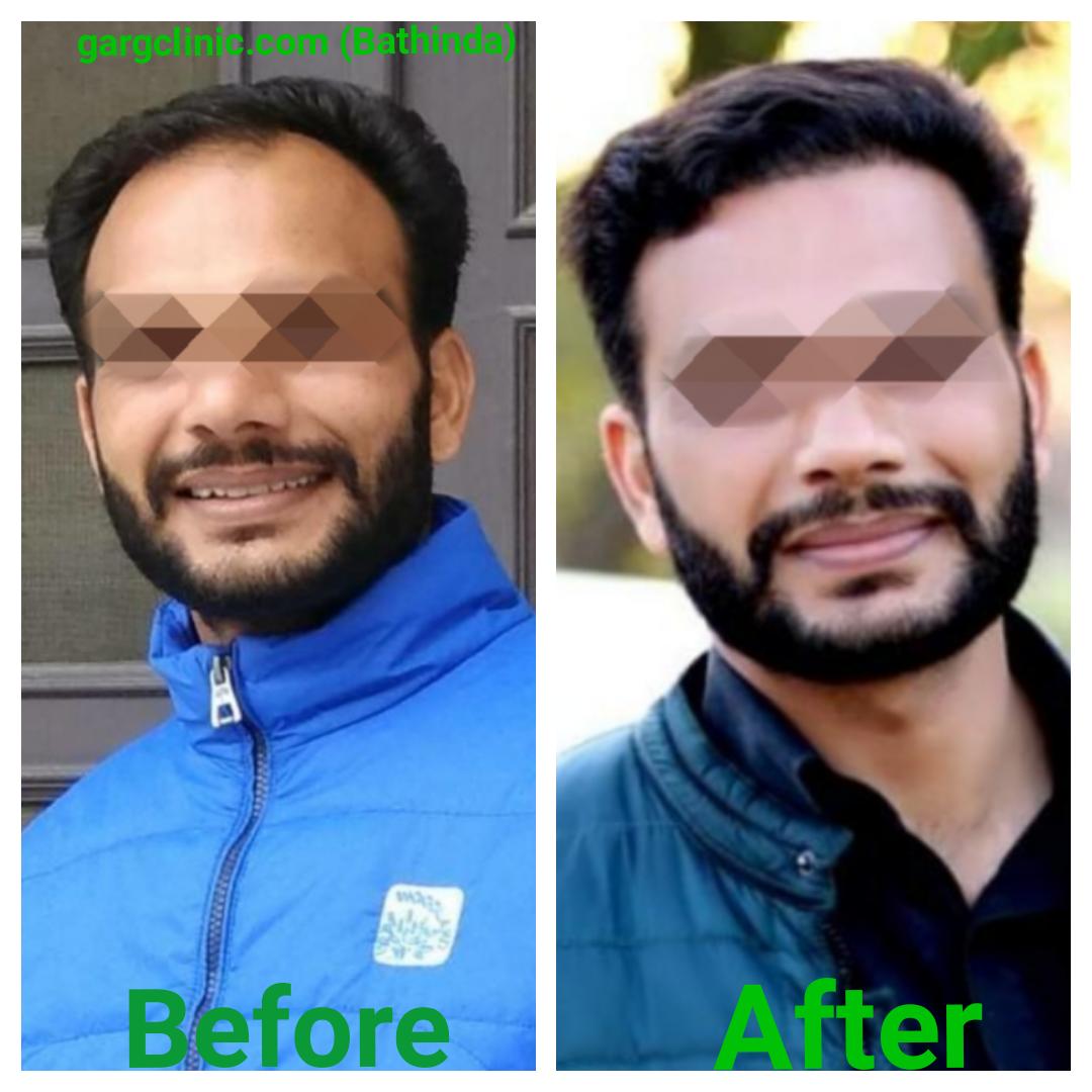 Garg Hair Transplant Clinic