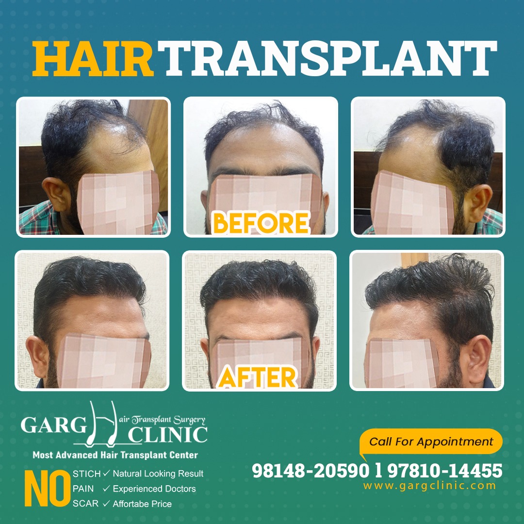 Garg Hair Transplant Clinic