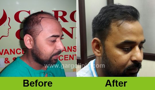 Garg Hair Transplant Clinic