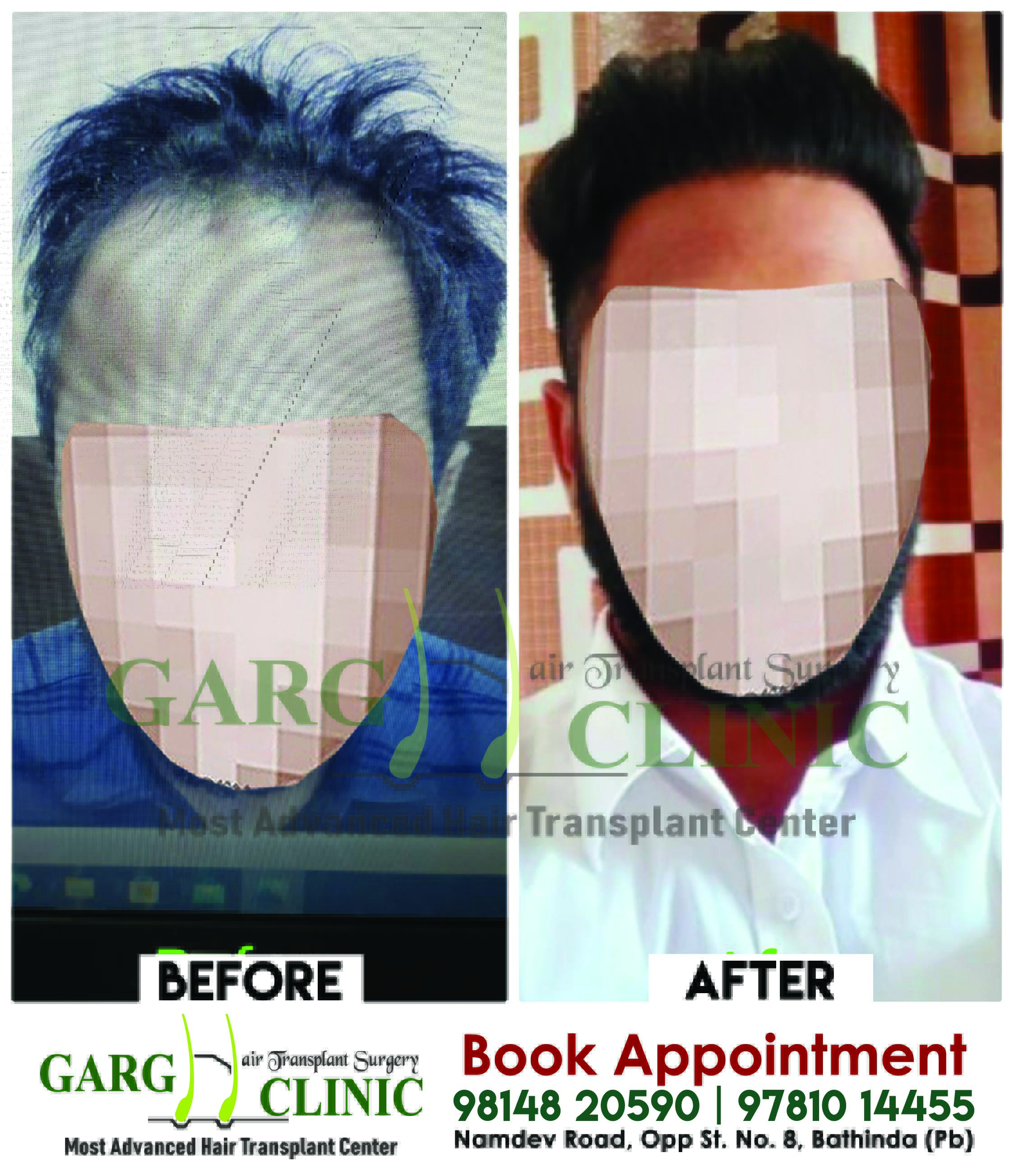 Garg Hair Transplant Clinic