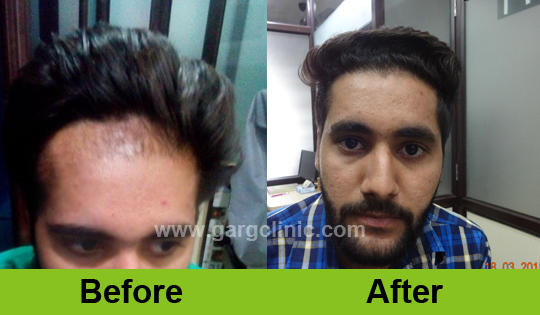 Garg Hair Transplant Clinic