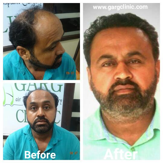 Garg Hair Transplant Clinic