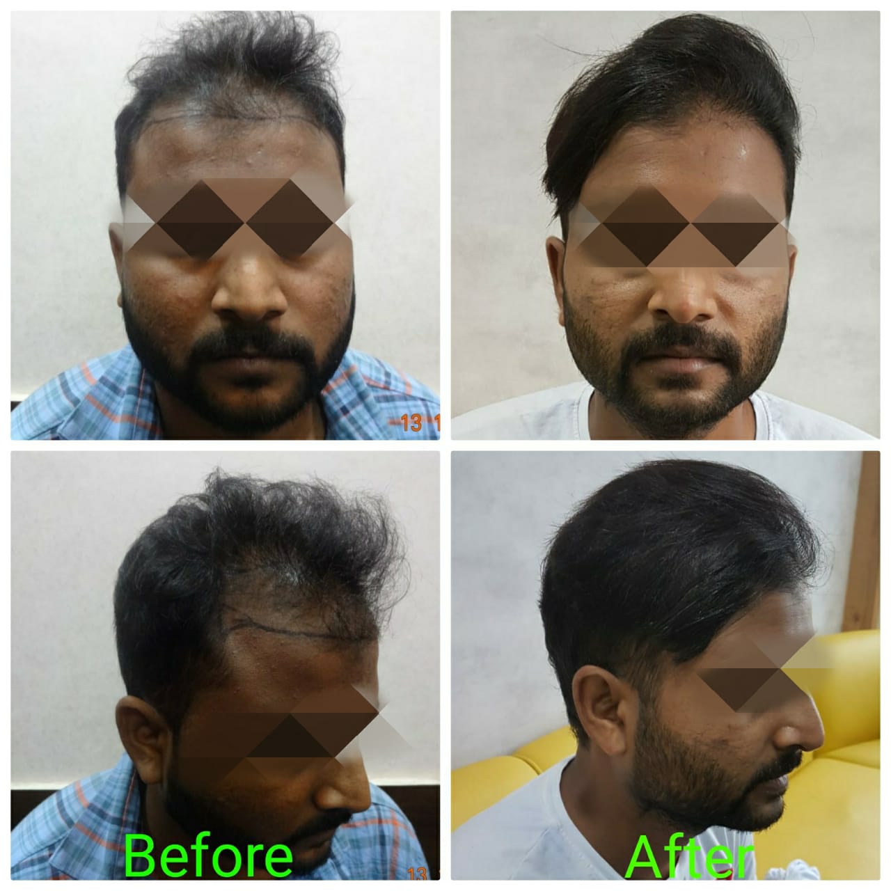 Garg Hair Transplant Clinic
