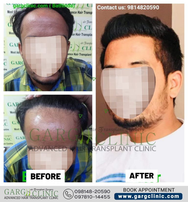 Garg Hair Transplant Clinic