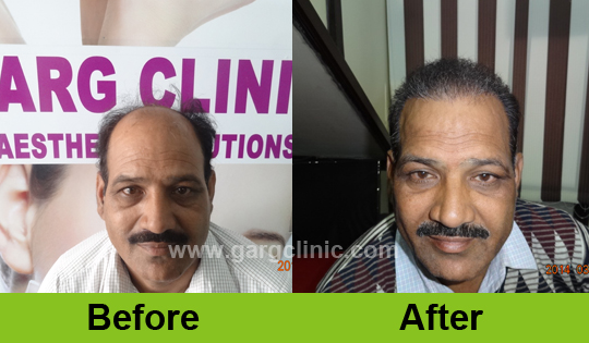 Garg Hair Transplant Clinic