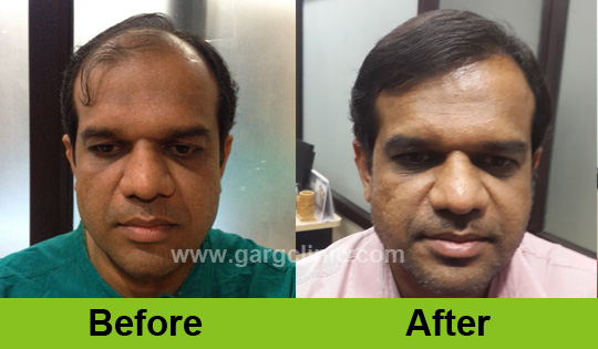 Garg Hair Transplant Clinic