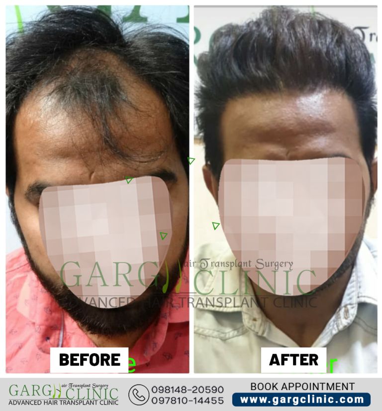 Garg Hair Transplant Clinic