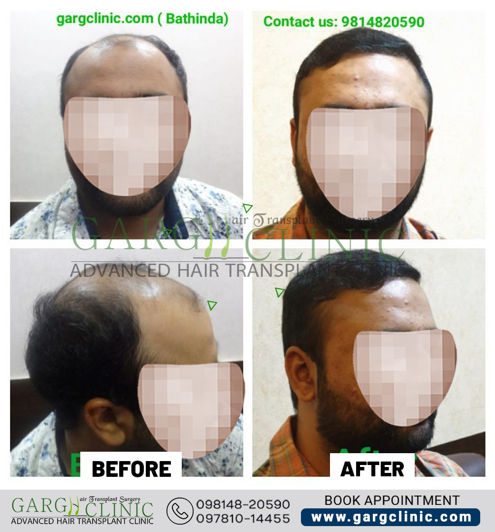 Garg Hair Transplant Clinic