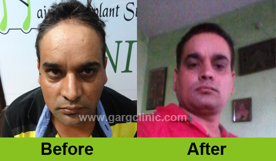 Garg Hair Transplant Clinic