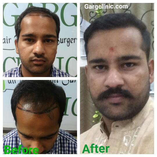 Garg Hair Transplant Clinic