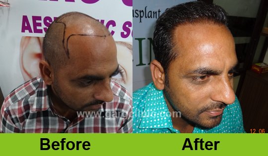 Garg Hair Transplant Clinic