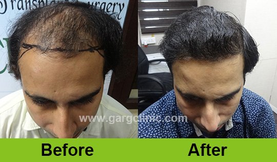 Garg Hair Transplant Clinic