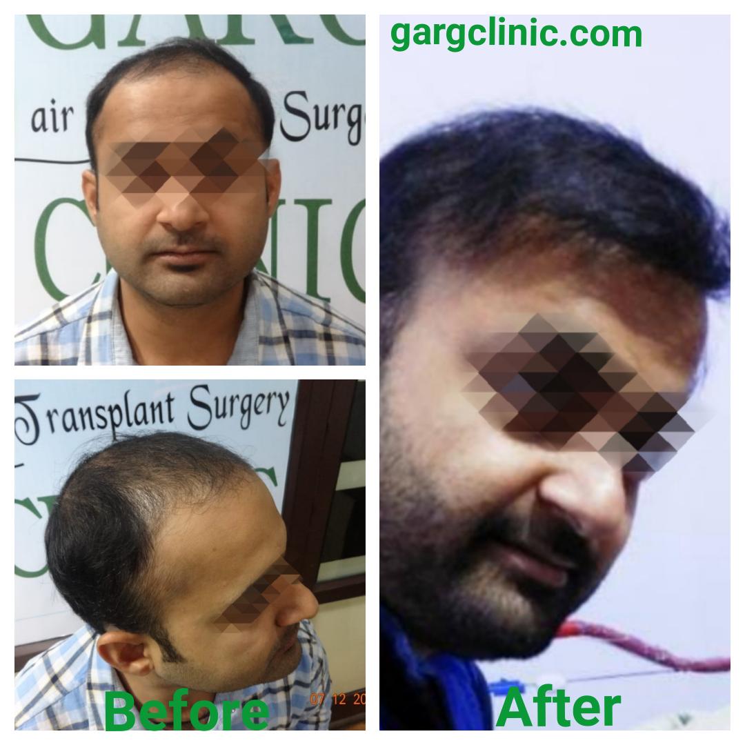 Garg Hair Transplant Clinic