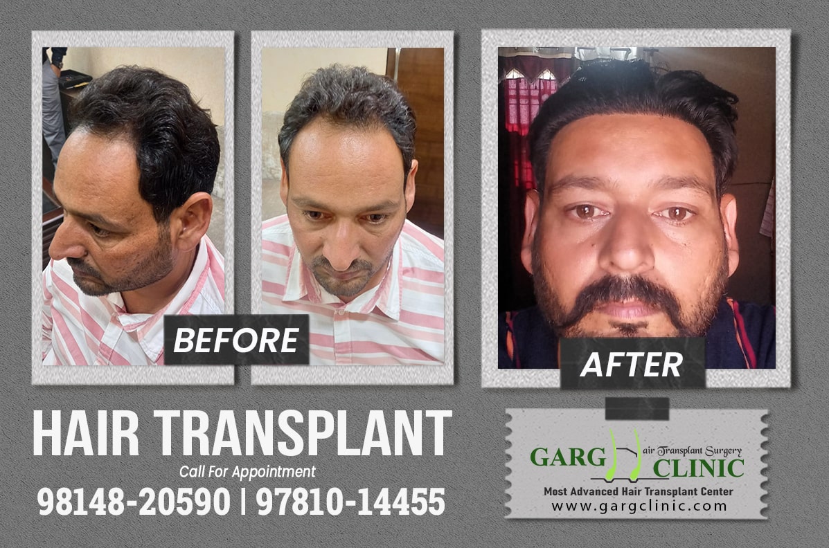 Garg Hair Transplant Clinic