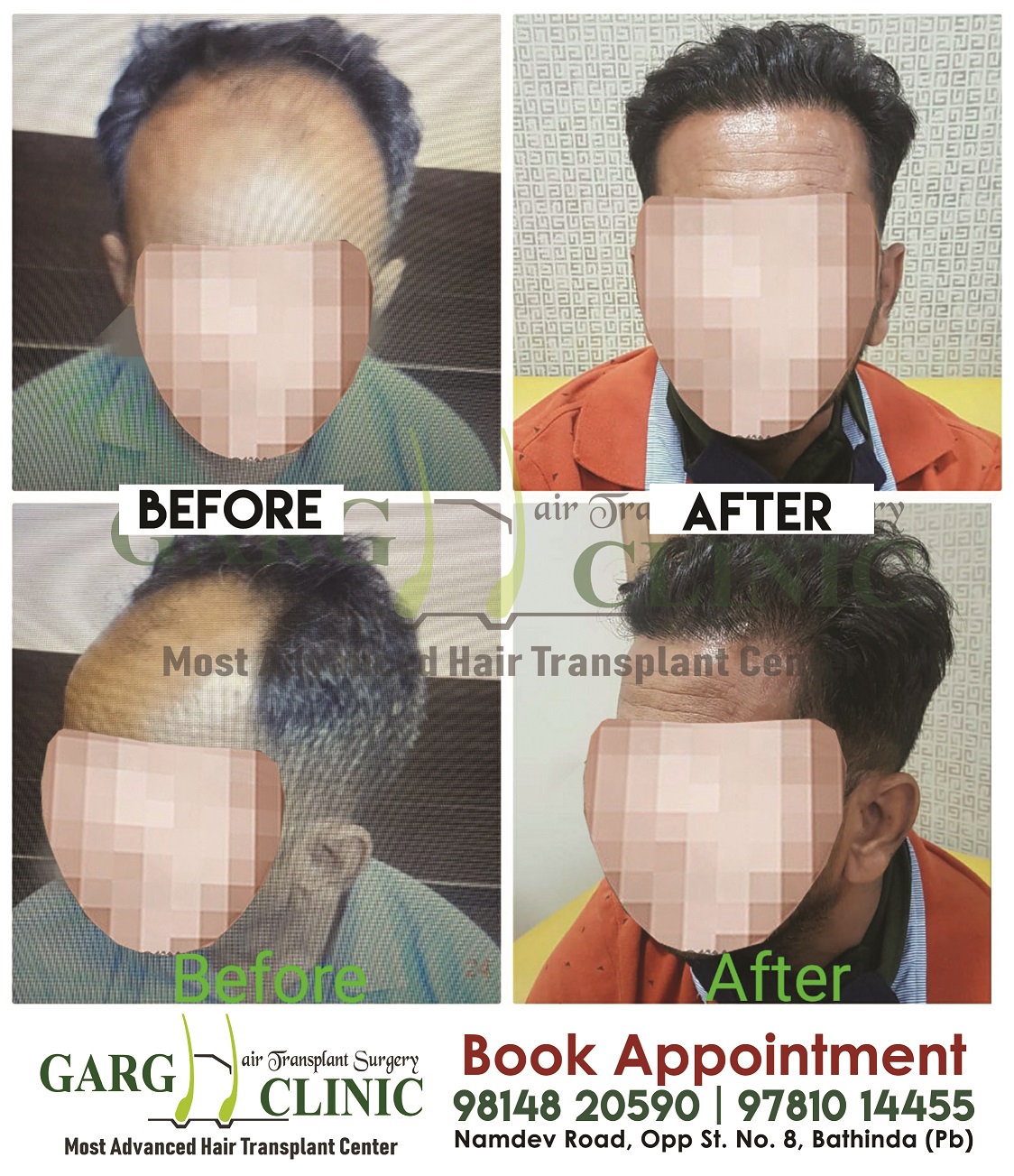 Garg Hair Transplant Clinic