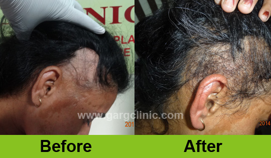 Garg Hair Transplant Clinic