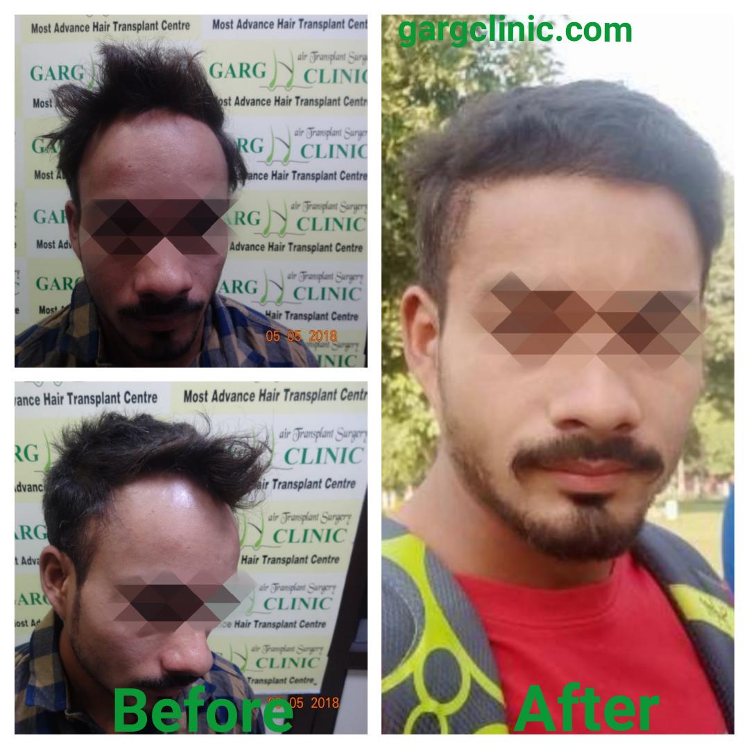 Garg Hair Transplant Clinic