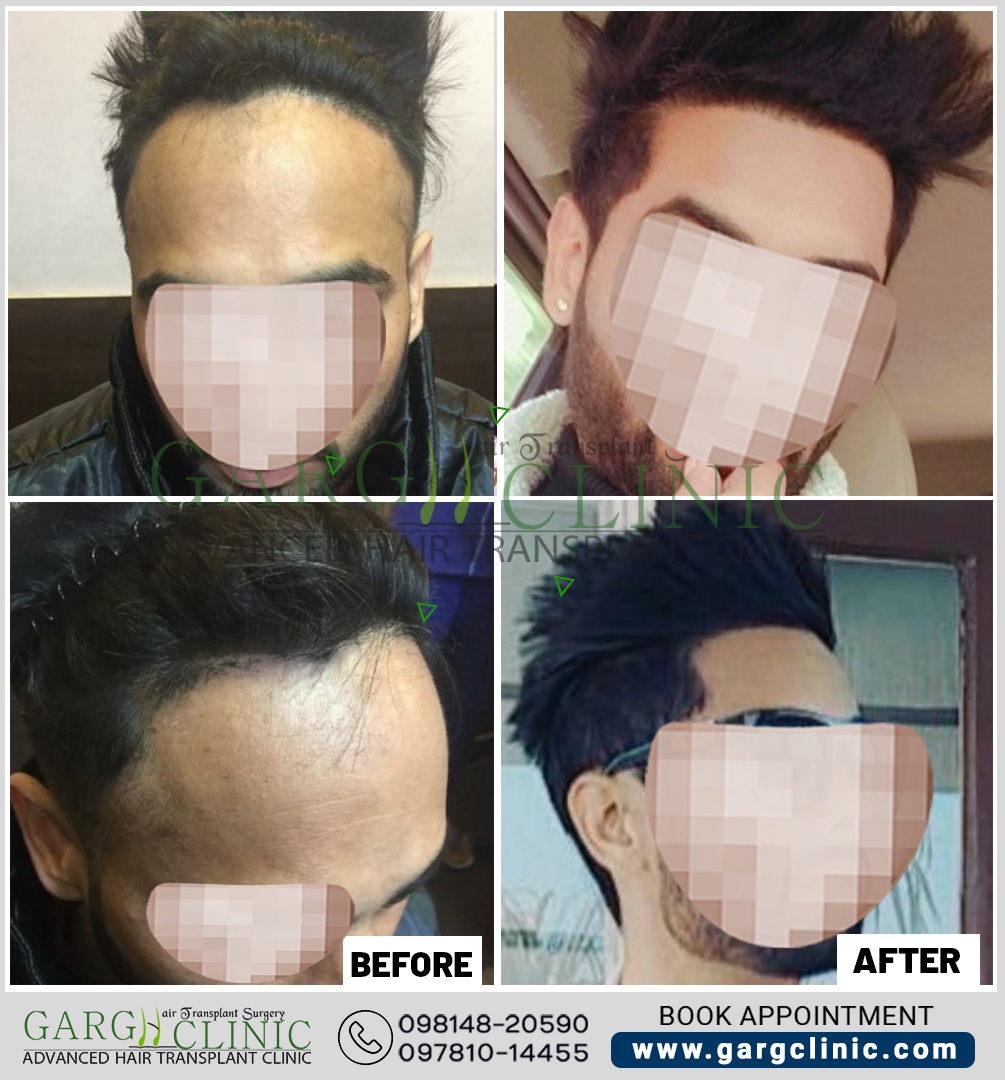 Garg Hair Transplant Clinic