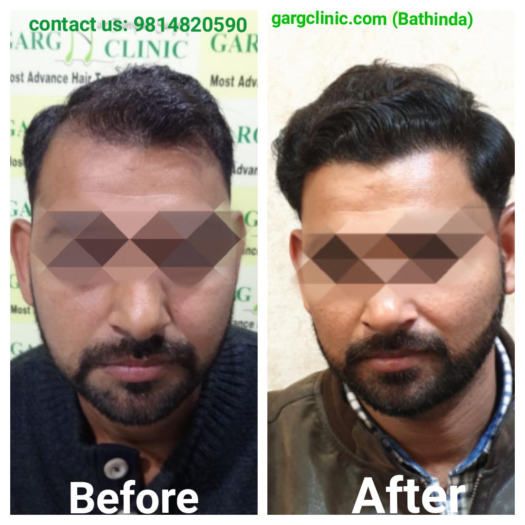 Garg Hair Transplant Clinic