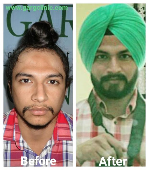 Garg Hair Transplant Clinic