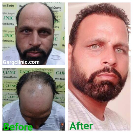 Garg Hair Transplant Clinic