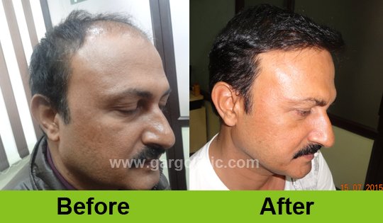 Garg Hair Transplant Clinic