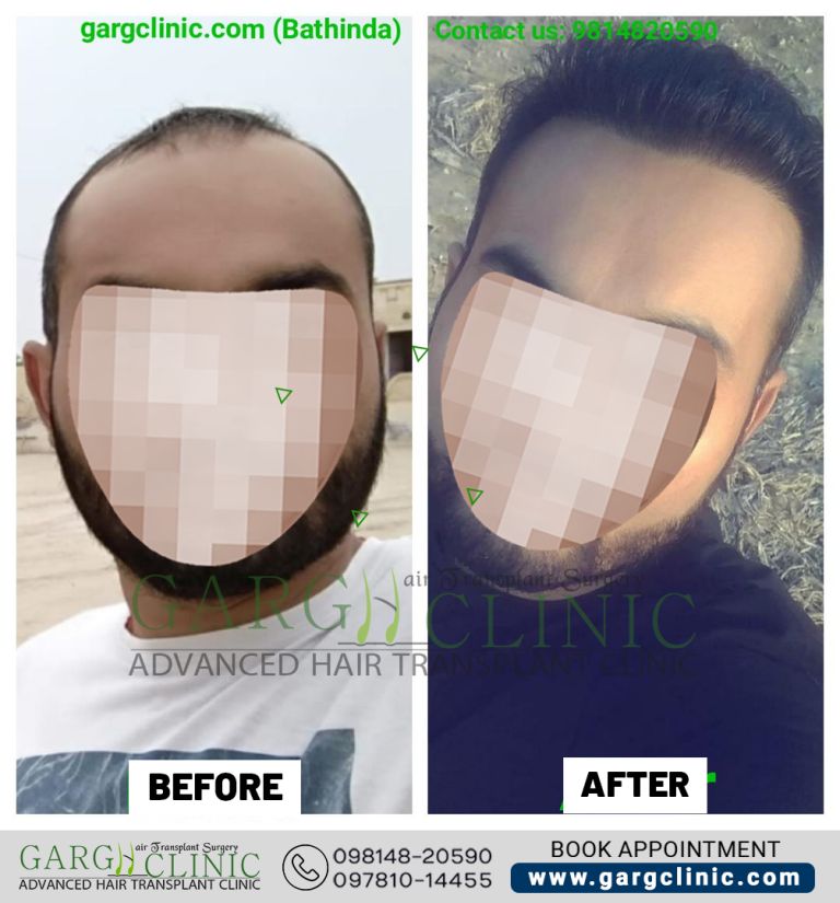 Garg Hair Transplant Clinic
