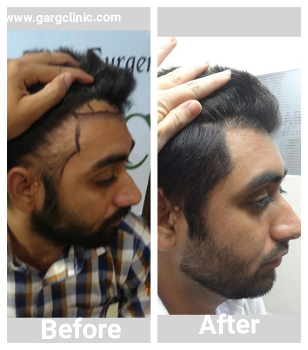 Garg Hair Transplant Clinic